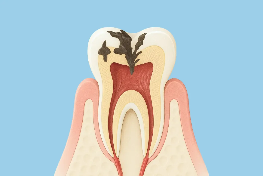 虫歯とはどんな病気？