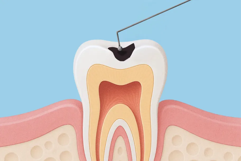 （柔らかくなった）虫歯を除去
