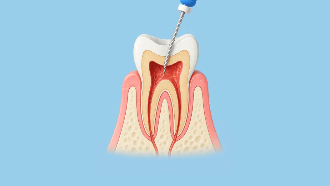 歯を残す治療(根管治療)