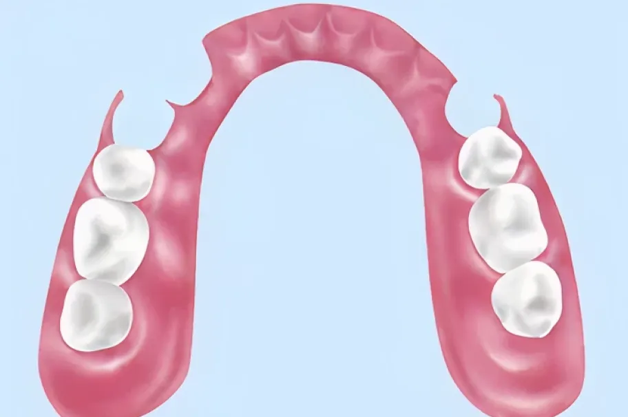 ノンクラスプデンチャー（自費）