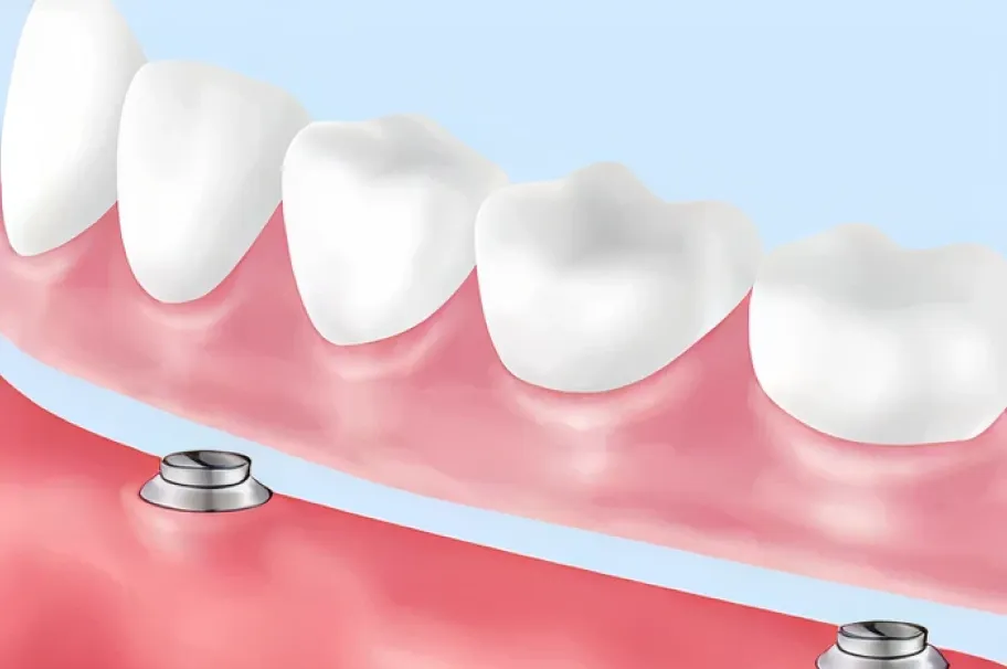 マグネットデンチャー（自費）