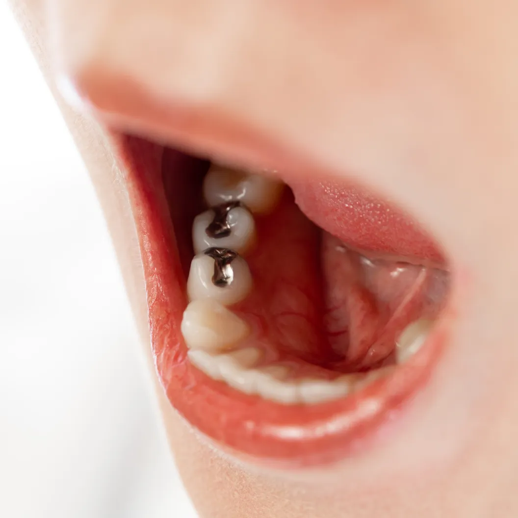 目立つ銀歯のお悩みを解消しませんか？