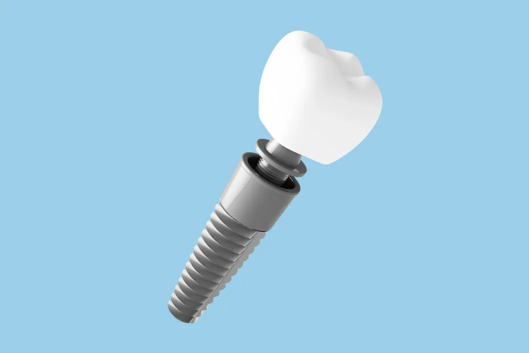 インプラント治療とは