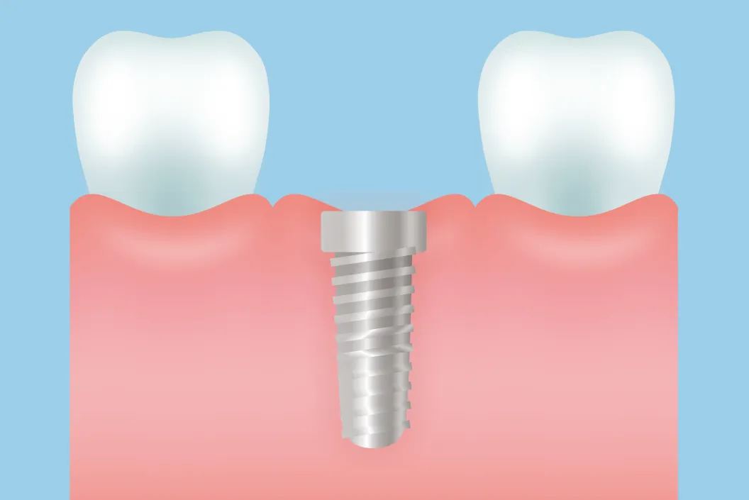 一次手術（インプラント埋入）