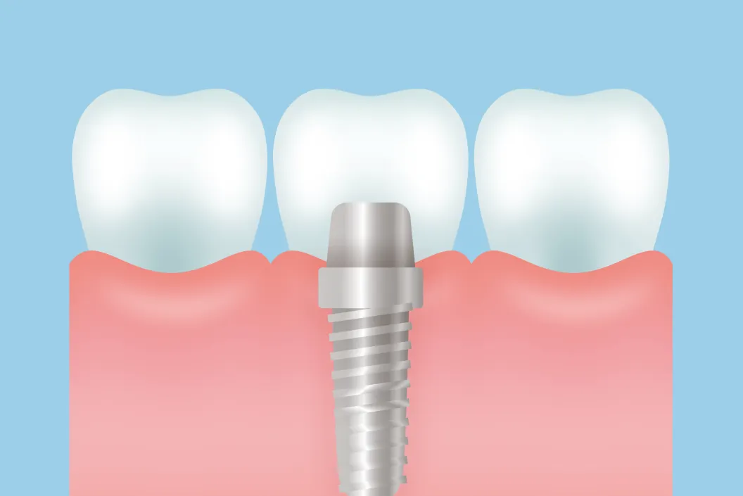 人工歯の製作・装着