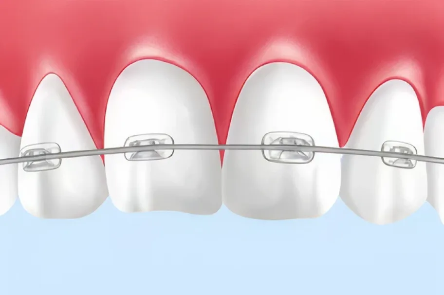唇側矯正（しんそくきょうせい）