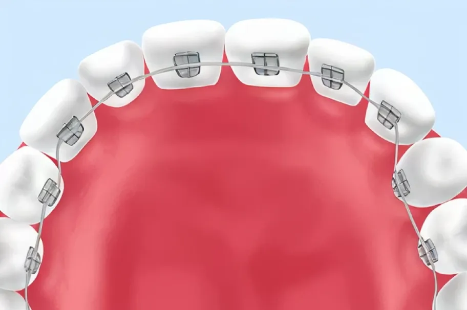 舌側矯正（ぜっそくきょうせい・裏側矯正）