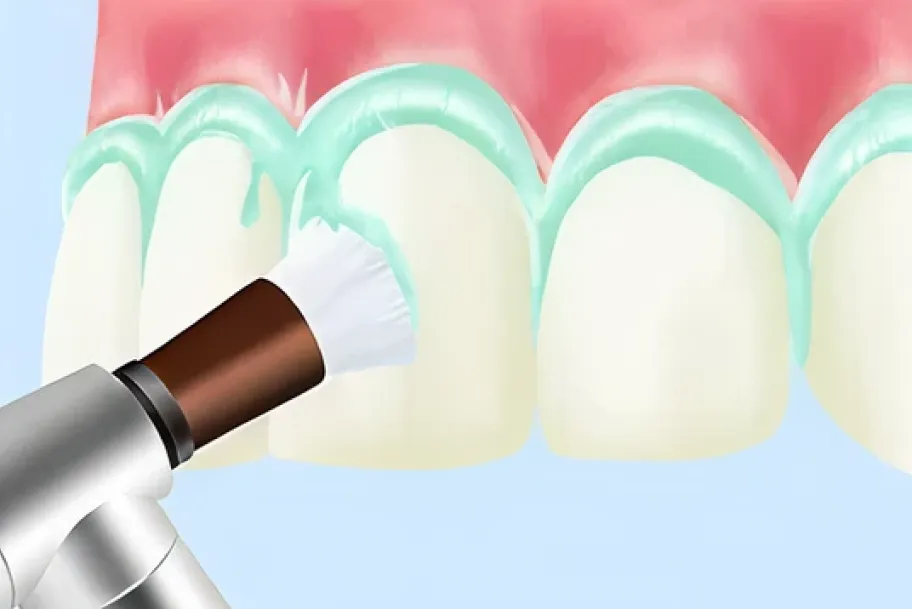 クリーニングペーストを塗布し、みがくことでバイオフィルム（細菌の塊）を除去します。