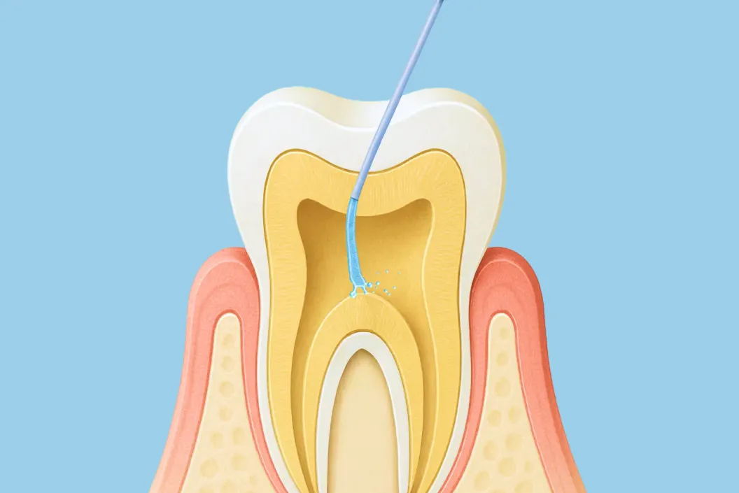 根管内を洗浄・消毒します。