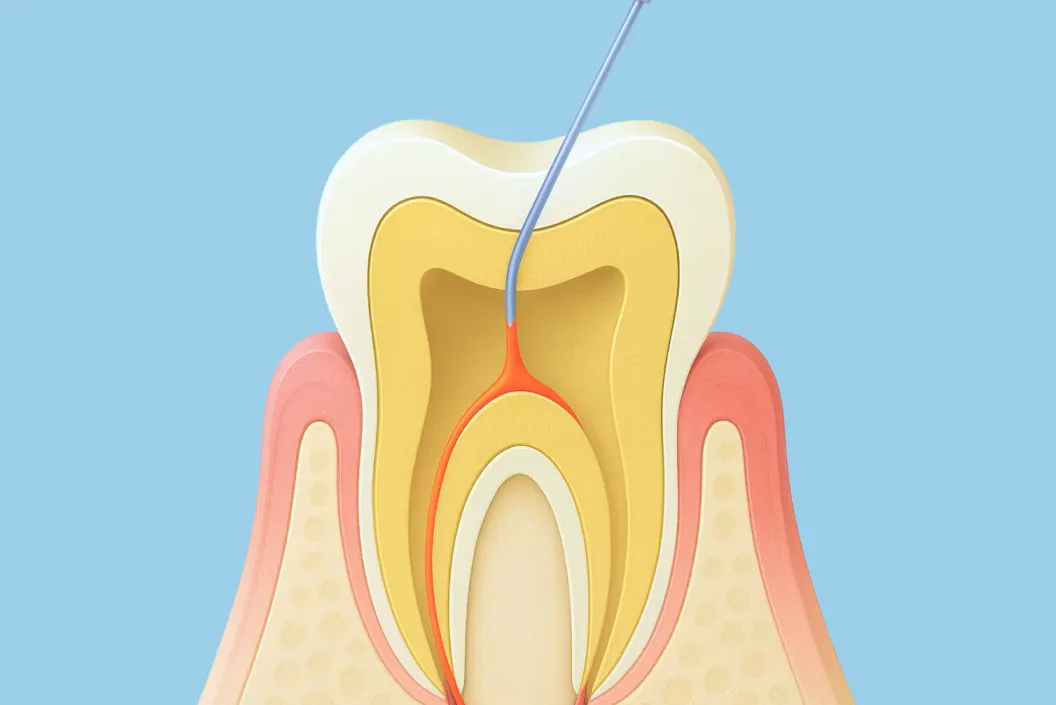 すき間ができないよう薬剤を充填します。