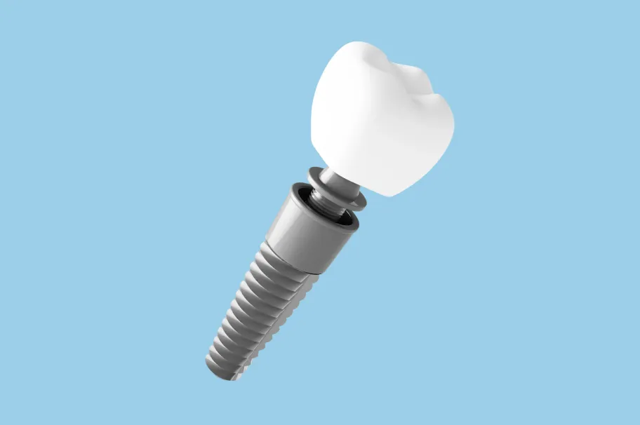 インプラント（自分の歯のように噛めるように）