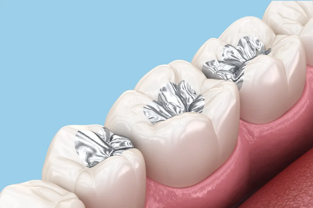 審美歯科（銀歯が気になる）