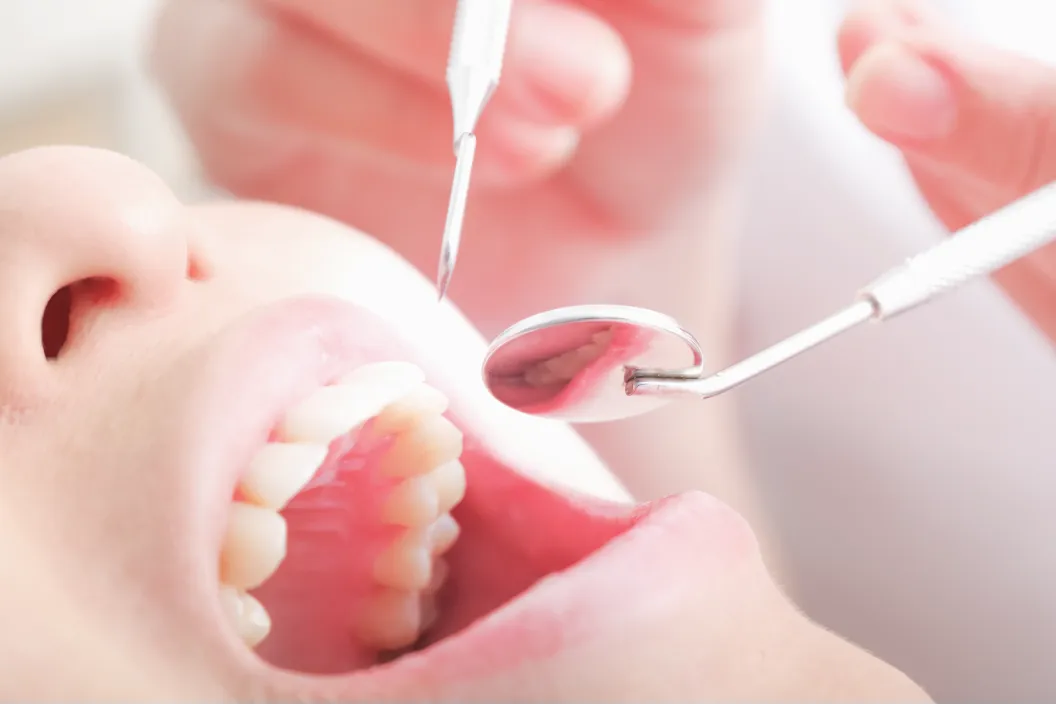 予防歯科（虫歯になりたくない）