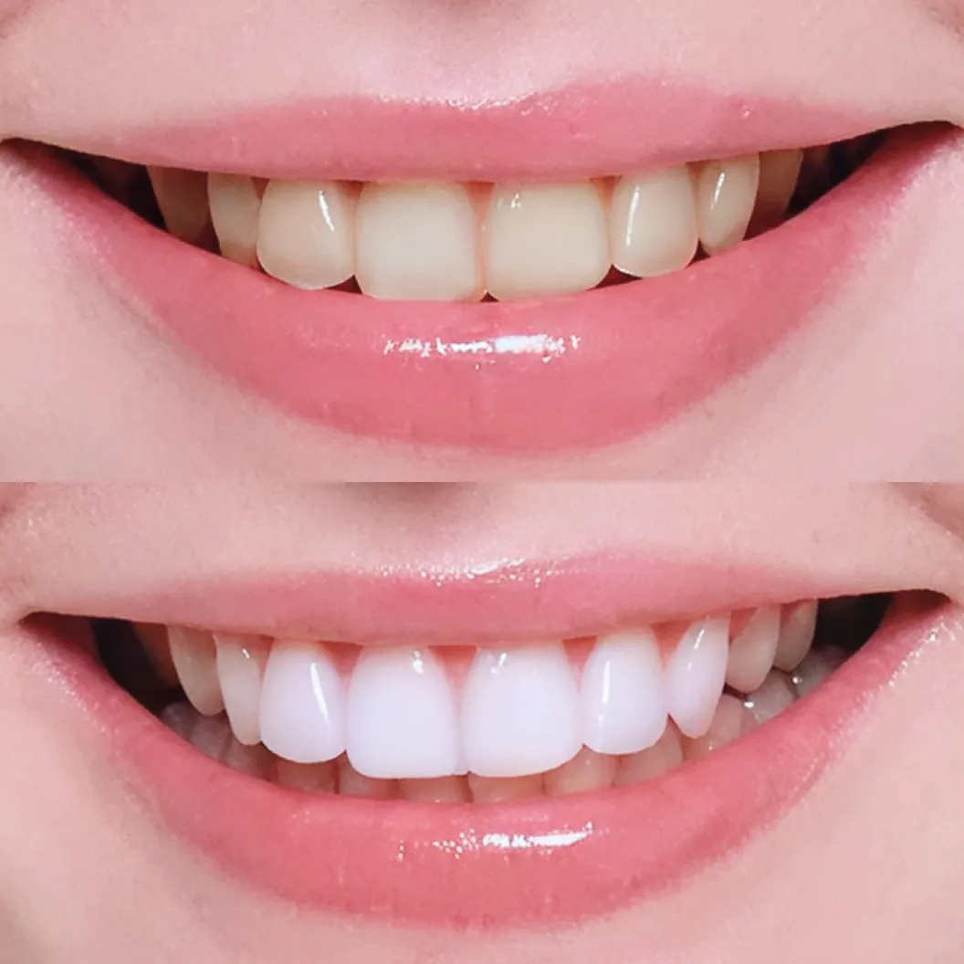 削らずに、自然な白さを取り戻す方法があります。